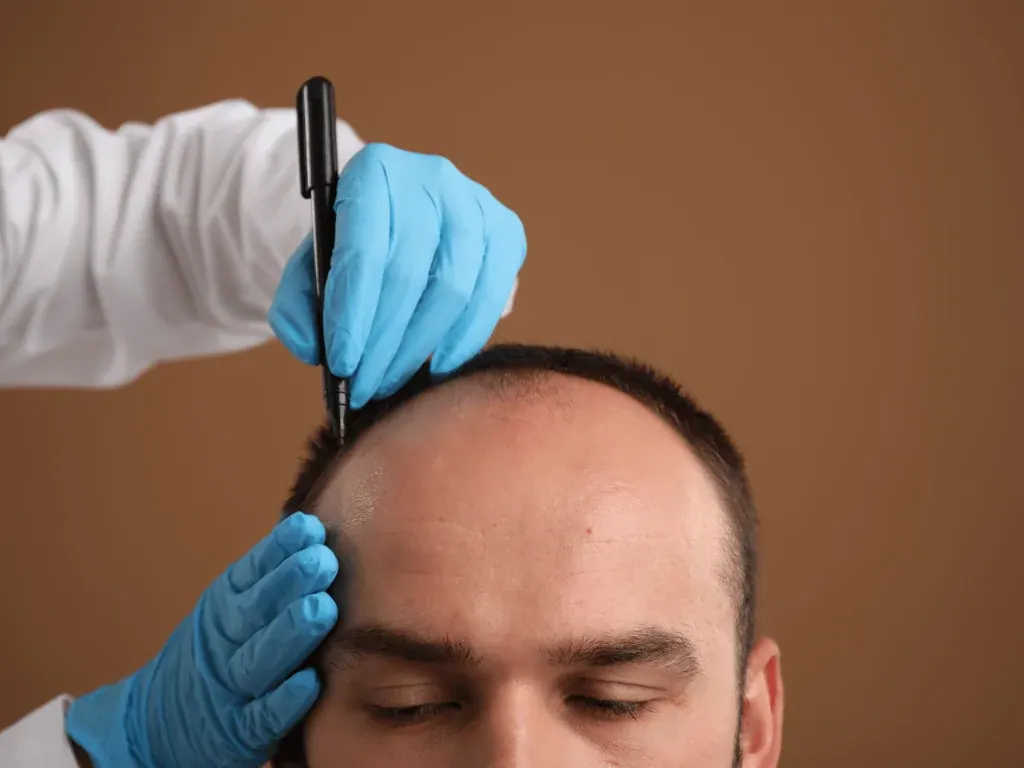 Hairline planning before a hair transplant