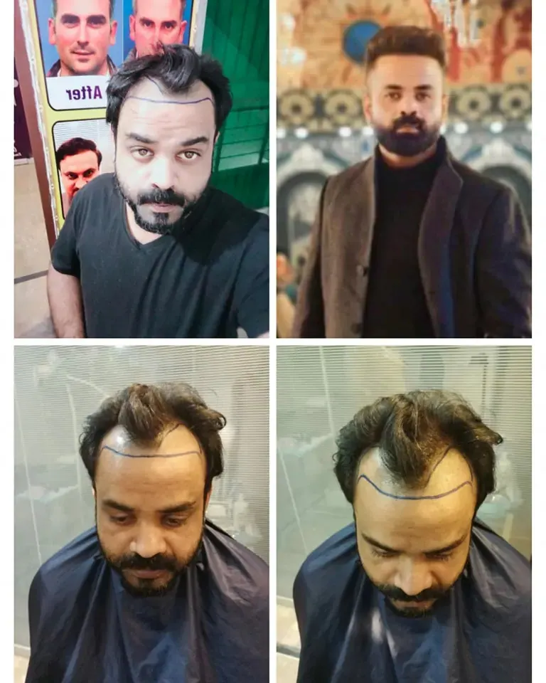 Photo collage showing a man’s scalp and hairline