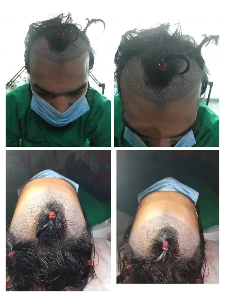 Photo collage showing a man’s scalp and hairline