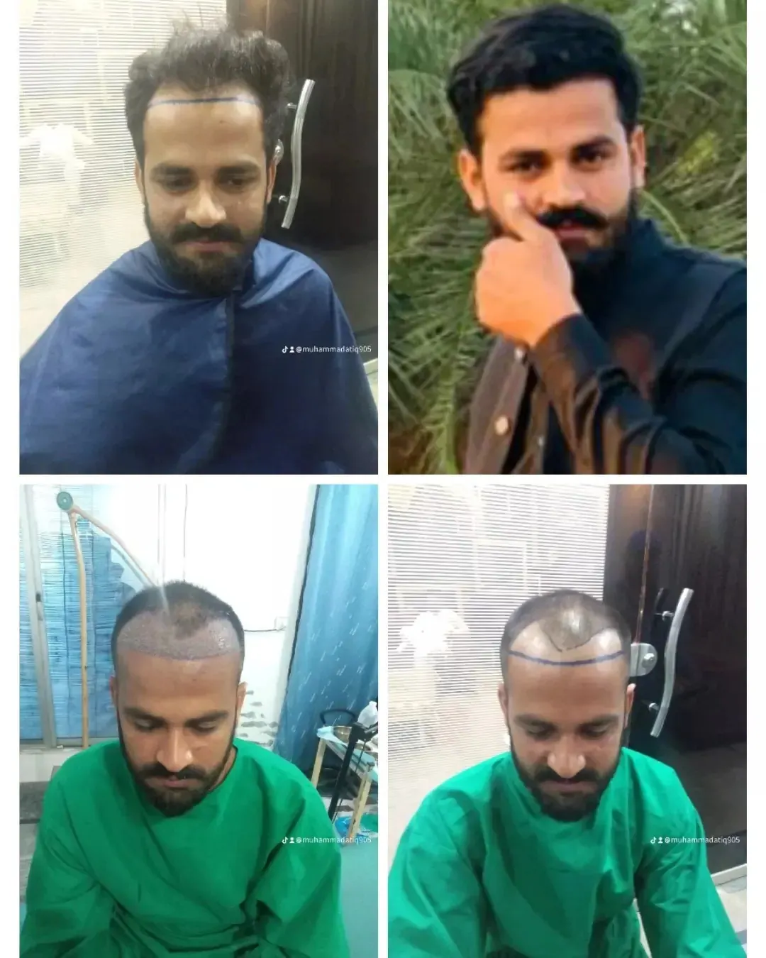 Photo collage showing a man’s scalp and hairline