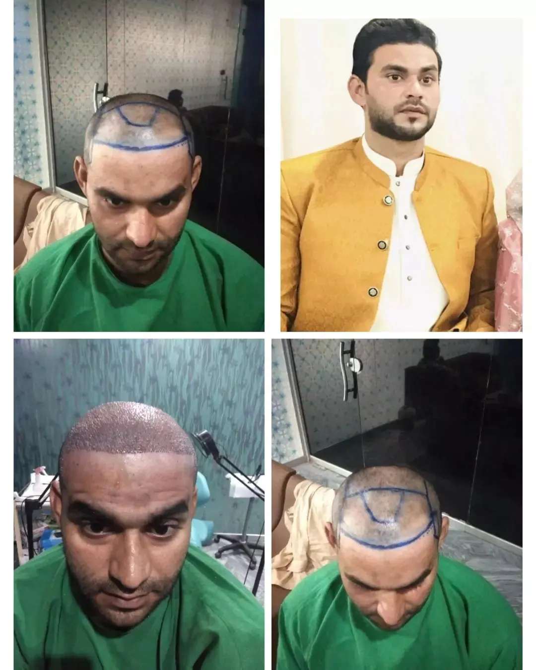 Photo collage showing a man’s scalp and hairline