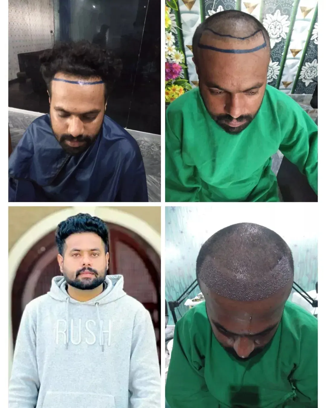 Photo collage showing a man’s scalp and hairline