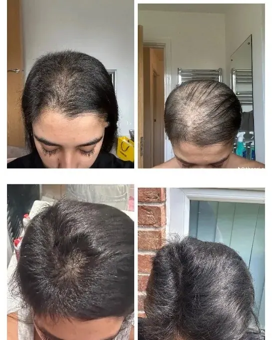 Photo collage showing a man’s scalp and hairline