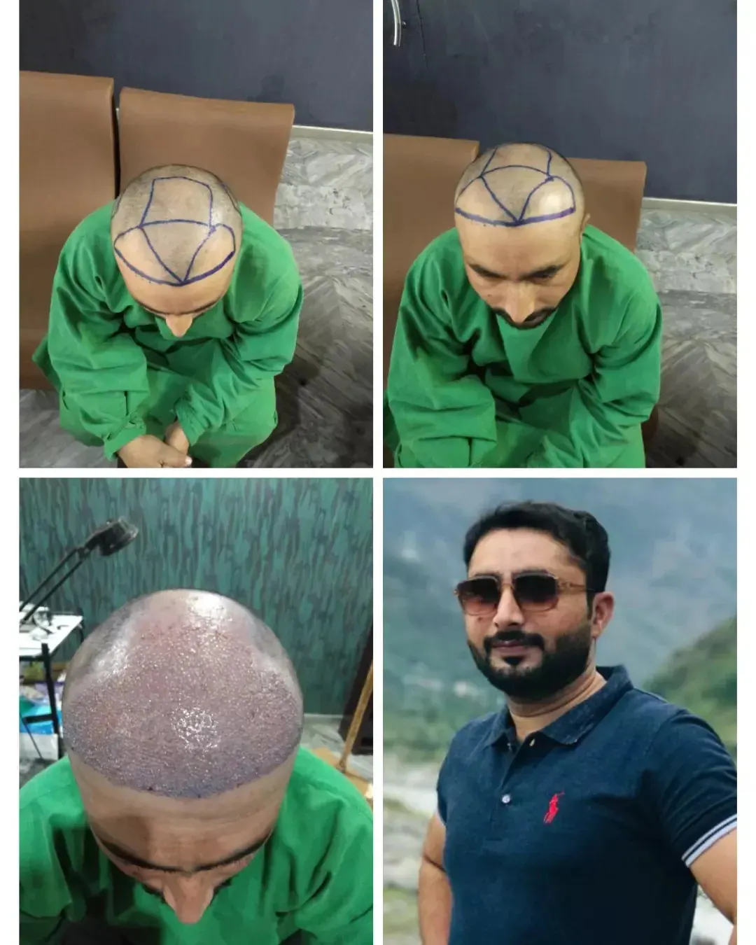 Photo collage showing a man’s scalp and hairline