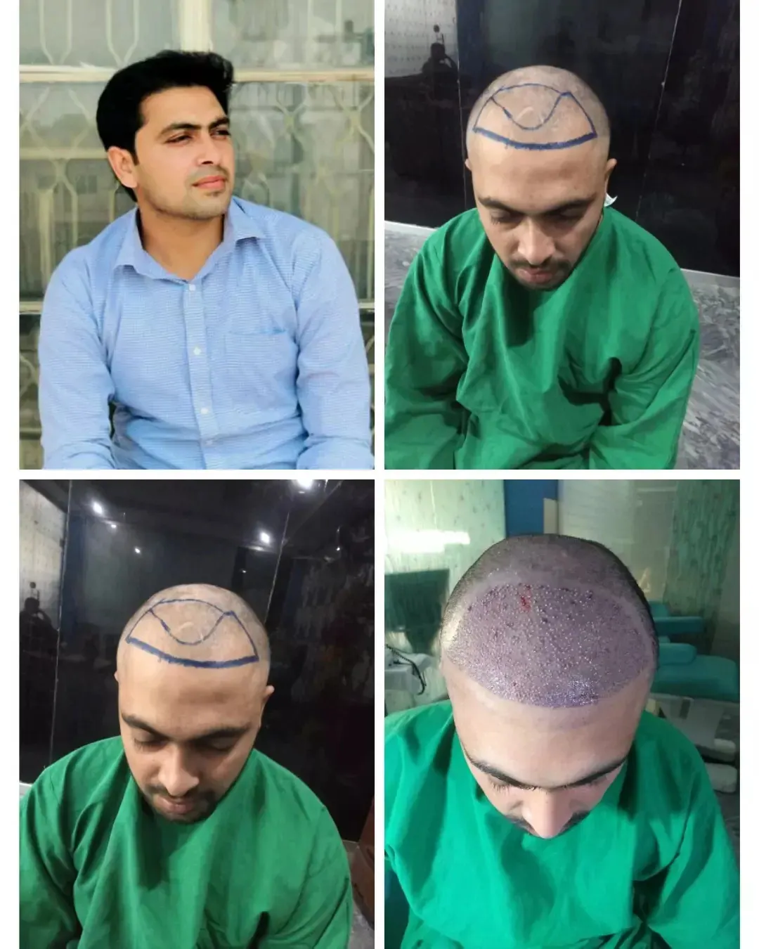 Photo collage showing a man’s scalp and hairline