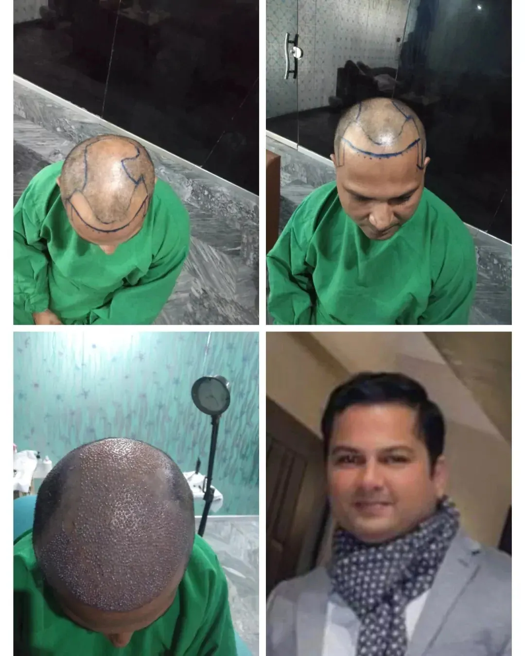 Photo collage showing a man’s scalp and hairline