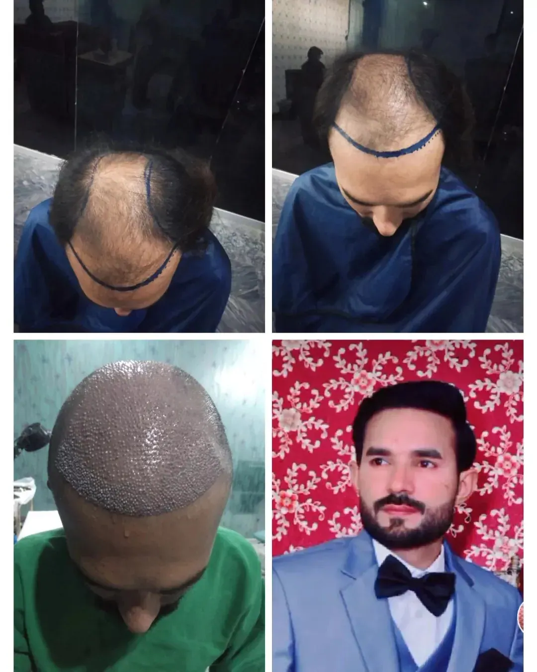 Photo collage showing a man’s scalp and hairline