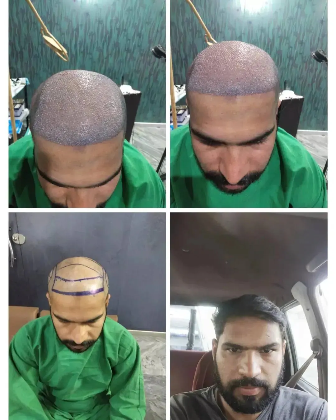 Photo collage showing a man’s scalp and hairline
