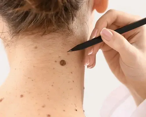 Treatment device held near a mole on the neck