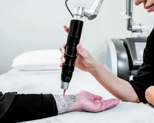 Treatment device held above a tattooed forearm