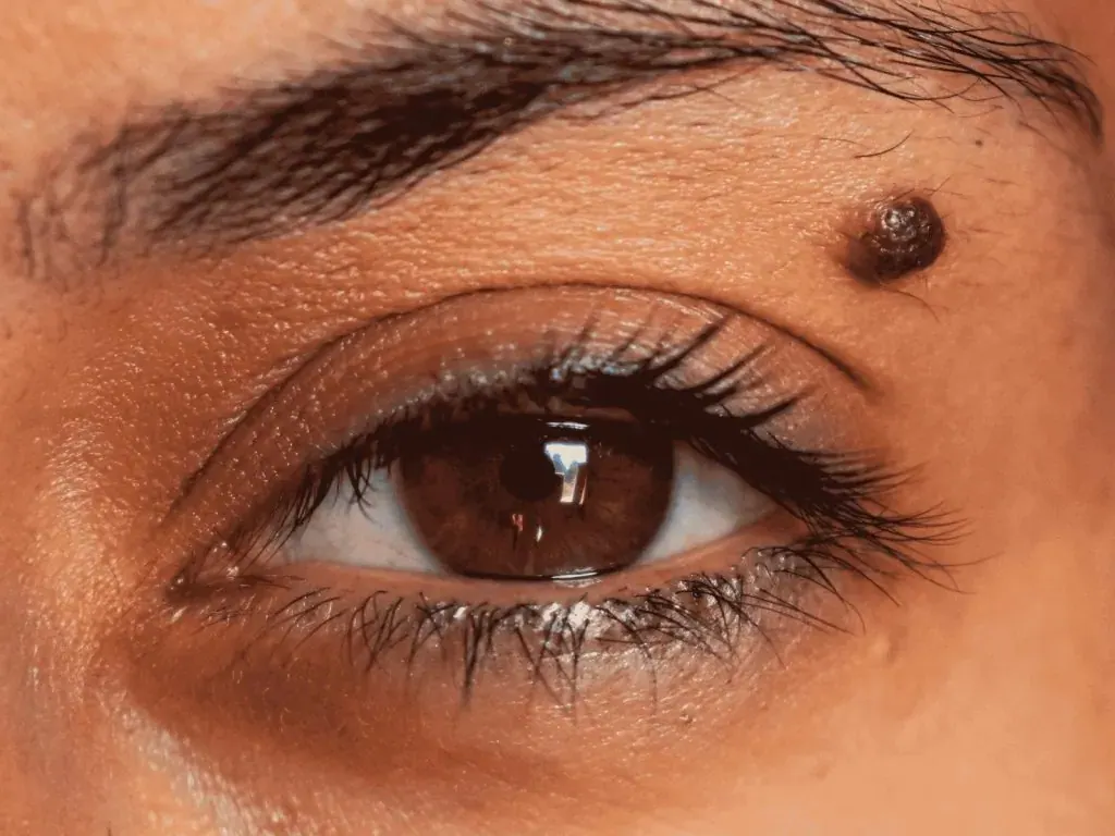 Close-up of a mole beside an eye