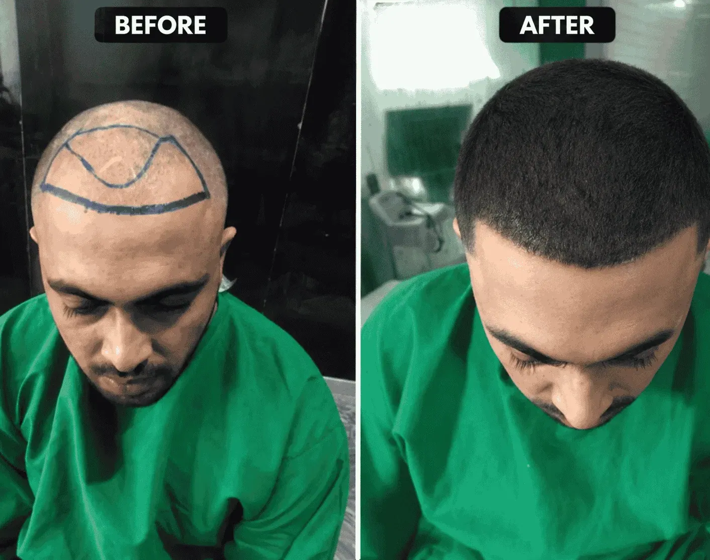 Side-by-side views of a man’s hairline